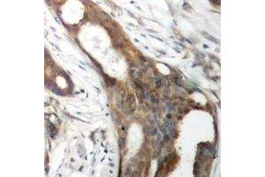 Immunohistochemical analysis of ASCT1 staining in human ovarian cancer formalin fixed paraffin embedded tissue section. (SLC1A4 抗体)