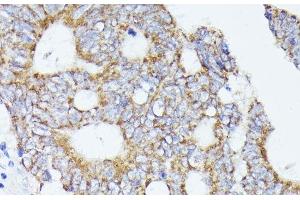 Immunohistochemistry of paraffin-embedded Human colon carcinoma using ACAT2 Polyclonal Antibody at dilution of 1:100 (40x lens). (ACAT2 抗体)