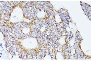 Immunohistochemistry of paraffin-embedded Human colon carcinoma using ACAT2 Polyclonal Antibody at dilution of 1:100 (40x lens).