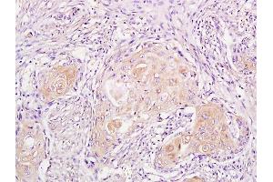 Formalin-fixed and paraffin embedded human endometrial cancer labeled with Anti-phospho-CDKN1A/P21 (Thr57) Polyclonal Antibody, Unconjugated (ABIN756877) followed by conjugation to the secondary antibody and DAB staining (p21 抗体  (pThr57))