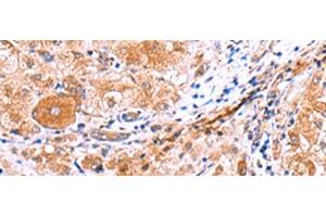 Immunohistochemistry of paraffin-embedded Human liver cancer tissue using IRGC Polyclonal Antibody at dilution of 1:30(x200) (IRGC 抗体)