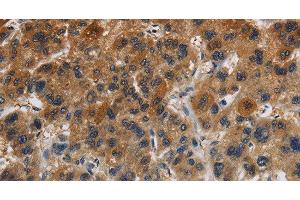 Immunohistochemistry of paraffin-embedded Human liver cancer tissue using Claudin 8 Polyclonal Antibody at dilution 1:50 (CLDN8 抗体)