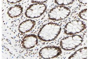 ABIN6267330 at 1/200 staining human colon carcinoma tissue sections by IHC-P. (HNRNPC 抗体  (pSer260))