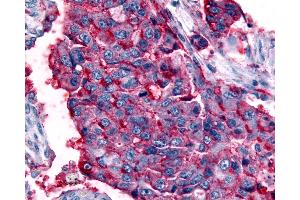 Anti-GPR63 antibody IHC of human Lung, Non-Small Cell Carcinoma. (GPR63 抗体  (Cytoplasmic Domain))