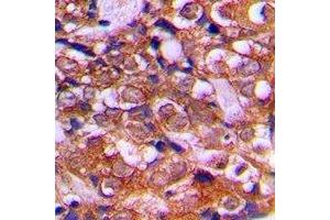 Immunohistochemical analysis of RPS12 staining in human prostate cancer formalin fixed paraffin embedded tissue section. (RPS12 抗体  (C-Term))