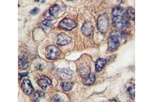 IHC analysis of FFPE human hepatocarcinoma tissue stained with PDGFR antibody (PDGFRA 抗体  (AA 698-727))