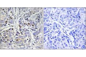 Immunohistochemistry analysis of paraffin-embedded human breast carcinoma tissue, using Centromeric Protein A (Ab-7) Antibody. (CENPA 抗体  (AA 1-50))