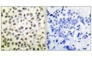 Immunohistochemical analysis of paraffin-embedded human colon carcinoma tissue using STAT5B (Ab-731) antibody. (STAT5B 抗体  (Ser731))