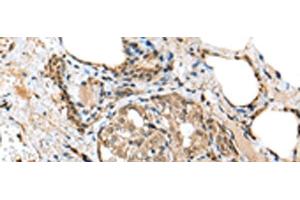 Immunohistochemistry of paraffin-embedded Human thyroid cancer tissue using TPPP Polyclonal Antibody at dilution of 1:25(x200) (Tppp 抗体)
