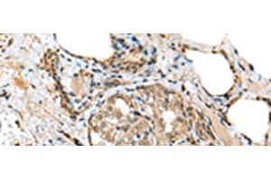 Immunohistochemistry of paraffin-embedded Human thyroid cancer tissue using TPPP Polyclonal Antibody at dilution of 1:25(x200) (Tppp 抗体)