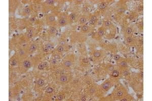 IHC image of ABIN7144415 diluted at 1:200 and staining in paraffin-embedded human liver cancer performed on a Leica BondTM system. (APOC1 抗体  (AA 35-48))