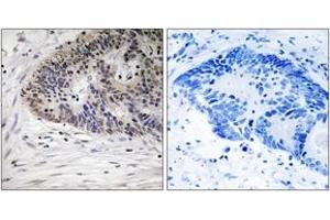Immunohistochemistry analysis of paraffin-embedded human colon carcinoma, using MDM4 (Phospho-Ser367) Antibody. (MDM4-binding Protein 抗体  (pSer367))