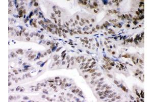 Anti- DAXX Picoband antibody,IHC(P) IHC(P): Human Intestinal Cancer Tissue (DAXX 抗体  (AA 56-345))
