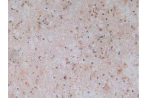 IHC-P analysis of Human Glioma Tissue, with DAB staining. (TLR9 抗体  (AA 28-362))