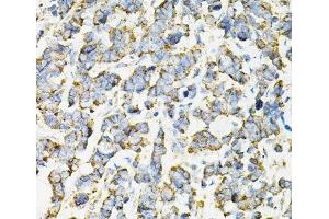 Immunohistochemistry of paraffin-embedded Human lung cancer using ADSS Polyclonal Antibody at dilution of 1:100 (40x lens). (ADSS 抗体)
