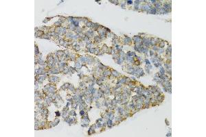 Immunohistochemistry of paraffin-embedded human esophageal cancer using PI3 antibody (ABIN6293676) at dilution of 1:100 (40x lens). (PI3 抗体)