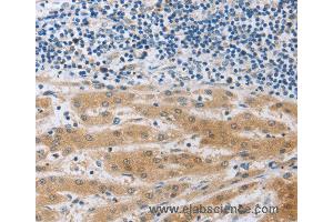 Immunohistochemistry of Human liver cancer using MUC20 Polyclonal Antibody at dilution of 1:40 (MUC20 抗体)