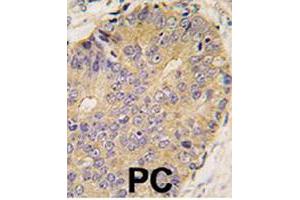 Formalin-fixed and paraffin-embedded human prostate carcinoma tissue reacted with BMP15 polyclonal antibody  , which was peroxidase-conjugated to the secondary antibody, followed by DAB staining. (BMP15 抗体  (Internal Region))