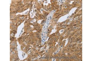Immunohistochemistry of Human ovarian cancer using CEBPA Polyclonal Antibody at dilution of 1:40 (CEBPA 抗体)