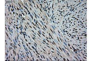 Immunohistochemical staining of paraffin-embedded Adenocarcinoma of colon tissue using anti-MAPK1mouse monoclonal antibody. (ERK2 抗体)