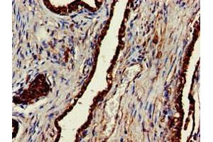 Immunohistochemistry of paraffin-embedded human prostate cancer using ABIN7147854 at dilution of 1:100 (CLINT1 抗体  (AA 1-625))