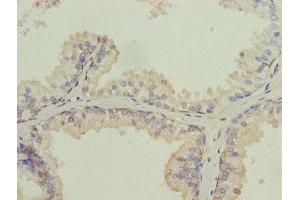 Immunohistochemistry of paraffin-embedded human prostate cancer using ABIN7157054 at dilution of 1:100 (ISCA2 抗体  (AA 9-154))