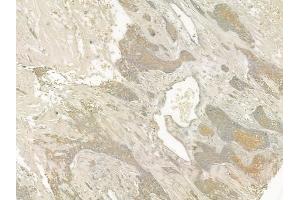 ABIN6260525 and ABIN6273205 at 1/100 staining human breast carcinoma by IHC-P. (CCBL1 抗体  (Internal Region))