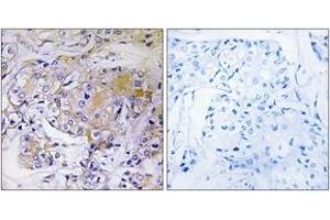 Immunohistochemistry analysis of paraffin-embedded human breast carcinoma tissue, using ULK3 Antibody. (ULK3 抗体  (AA 141-190))