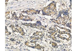 ABIN7096110 and ABIN7100172 at 1/100 staining human colorectal cancer by IHC-P. (LAPTM5 抗体)