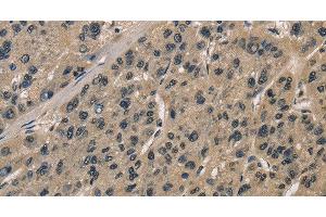 Immunohistochemistry of paraffin-embedded Human liver cancer tissue using CCAR1 Polyclonal Antibody at dilution 1:40 (CCAR1 抗体)
