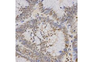 Immunohistochemistry of paraffin-embedded human rectal cancer using TriMethyl-Histone H3-K79 antibody.
