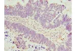 Immunohistochemistry of paraffin-embedded human ovarian cancer using ABIN7150033 at dilution of 1:100 (DAAM2 抗体  (AA 1-86))