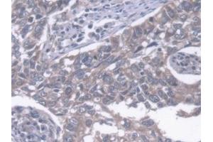 Detection of ERLIN2 in Human Lung cancer Tissue using Polyclonal Antibody to Endoplasmic Reticulum Lipid Raft Associated Protein 2 (ERLIN2) (ERLIN2 抗体  (AA 47-339))