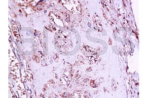 Formalin-fixed and paraffin embedded human placenta tissue labeledwith Anti-Phospho-Estrogen Receptor alpha (Ser167) Polyclonal Antibody, Unconjugated (ABIN729493) at 1:200, followed by conjugation to the secondary antibody and DAB staining (Estrogen Receptor alpha 抗体  (pSer167))