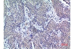 Immunohistochemistry (IHC) analysis of paraffin-embedded Human Mammary Cancer, antibody was diluted at 1:100. (PDGFD 抗体  (C-Term))