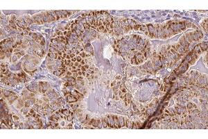 ABIN6267088 at 1/100 staining Human thyroid cancer tissue by IHC-P. (CDC25B 抗体  (pSer151))