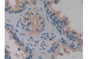 Detection of PTI in Human Prostate Tissue using Polyclonal Antibody to Placental Thrombin Inhibitor (PTI) (SERPINB6 抗体  (AA 1-376))