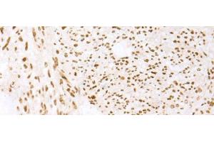Immunohistochemistry of paraffin-embedded Human liver cancer tissue using TCOF1 Polyclonal Antibody at dilution of 1:50(x200) (TCOF1 抗体)