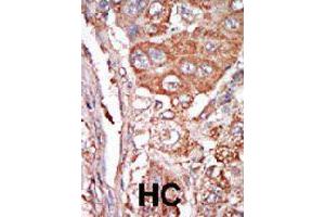 Formalin-fixed and paraffin-embedded human hepatocellular carcinoma tissue reacted with FGF4 polyclonal antibody  , which was peroxidase-conjugated to the secondary antibody, followed by DAB staining. (FGF4 抗体  (C-Term))