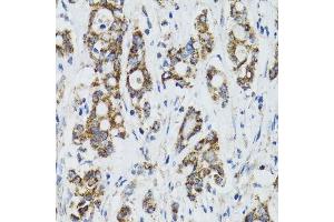Immunohistochemistry of paraffin-embedded human colon carcinoma using SURF1 antibody. (SURF1 抗体  (AA 80-275))