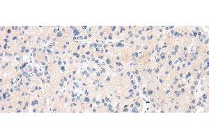 Immunohistochemistry of paraffin-embedded Human liver cancer tissue using MUC7 Polyclonal Antibody at dilution 1:30 (MUC7 抗体)