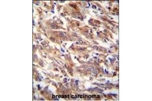 FBXW12 Antibody (C-term) (ABIN654226 and ABIN2844060) immunohistochemistry analysis in formalin fixed and paraffin embedded human breast carcinoma followed by peroxidase conjugation of the secondary antibody and DAB staining. (FBXW12 抗体  (C-Term))