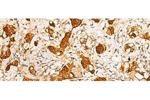 Immunohistochemistry of paraffin-embedded Human liver cancer tissue using C11orf54 Polyclonal Antibody at dilution of 1:50(x200) (C11orf54 抗体)