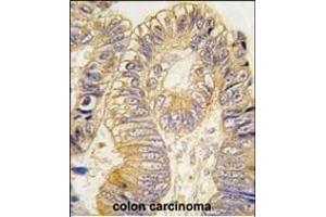 Formalin-fixed and paraffin-embedded human colon carcinoma tissue reacted with CLIC5 antibody (ABIN391843 and ABIN2841681) , which was peroxidase-conjugated to the secondary antibody, followed by DAB staining. (CLIC5 抗体)