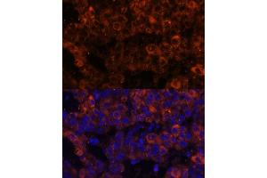 Immunofluorescence analysis of human liver cancer using PAI-1/Serpin E1 Polyclonal Antibody (ABIN6131330, ABIN6147601, ABIN6147603 and ABIN6221802) at dilution of 1:100 (40x lens). (PAI1 抗体  (AA 24-402))