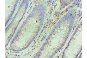 Immunohistochemistry of paraffin-embedded human colon cancer using ABIN7156763 at dilution of 1:100 (IL1RN 抗体  (AA 22-230))