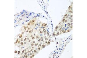 Immunohistochemistry of paraffin-embedded human lung cancer using BCAS2 antibody. (BCAS2 抗体  (AA 1-225))