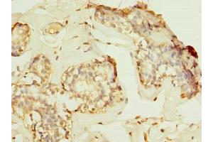 Immunohistochemistry of paraffin-embedded human breast cancer using ABIN7155221 at dilution of 1:100 (HPCAL1 抗体  (AA 2-193))