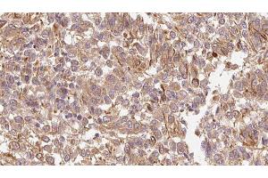 ABIN6278314 at 1/100 staining Human Melanoma tissue by IHC-P. (LEFTY2 抗体  (Internal Region))