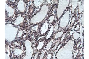 Immunohistochemical staining of paraffin-embedded Carcinoma of Human thyroid tissue using anti-C20orf3 mouse monoclonal antibody. (APMAP 抗体)